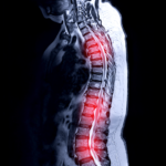 Spinal Cord Injury from Car Accident