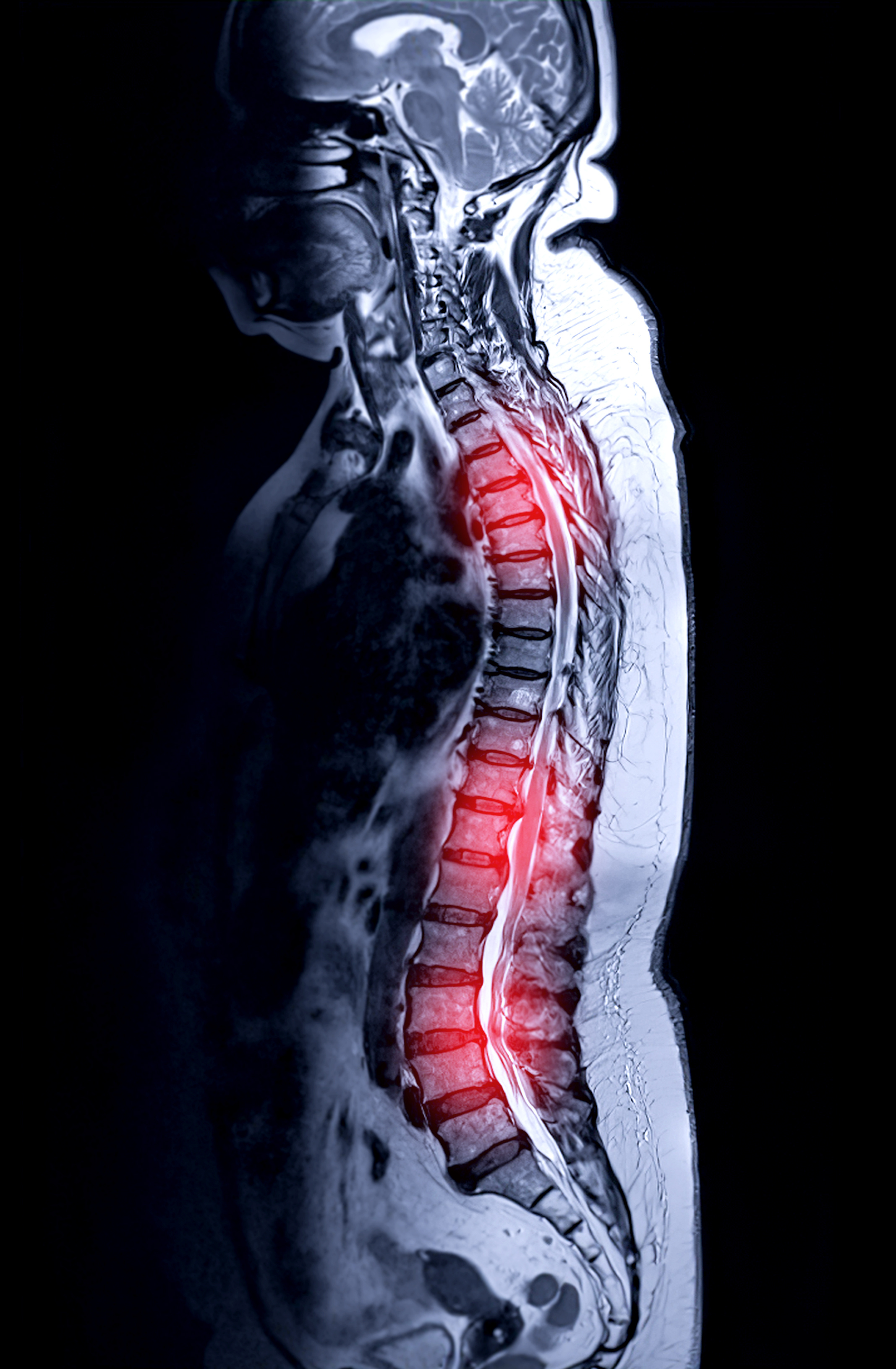 You are currently viewing Spinal Cord Injury from Car Accident